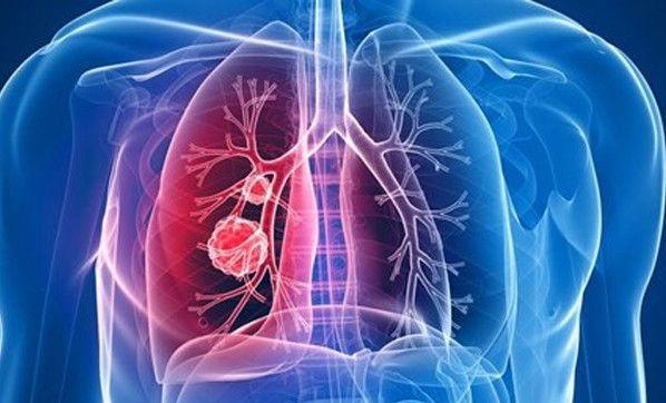 Akciğer sertleşmesi tedavisinde ÖNEMLİ Yeni gelişmeler 3