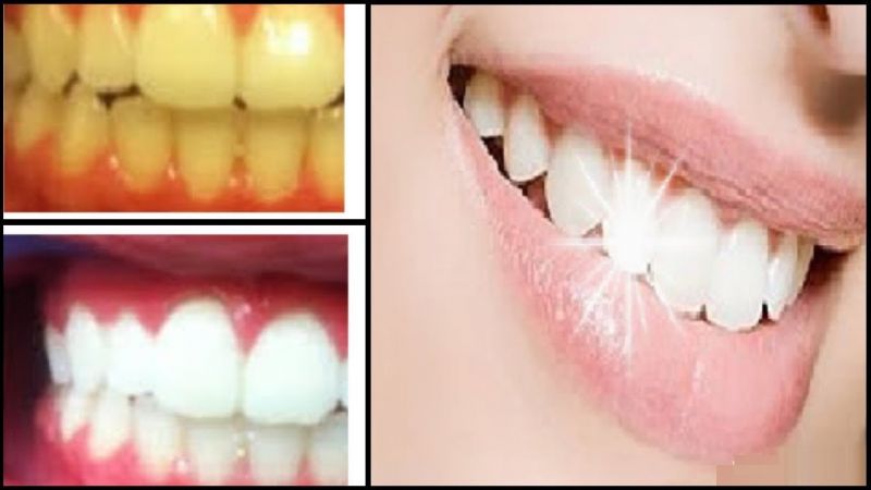 Dişler neden sararır! Sararan Diş Problemi Nasıl Çözülür? 5