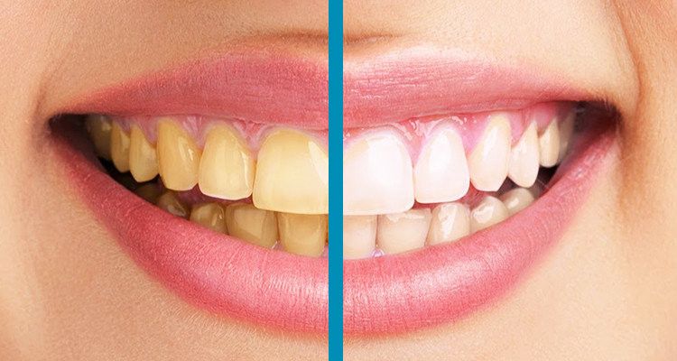 Dişler neden sararır! Sararan Diş Problemi Nasıl Çözülür? 1
