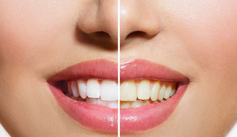 Dişler neden sararır! Sararan Diş Problemi Nasıl Çözülür? 3