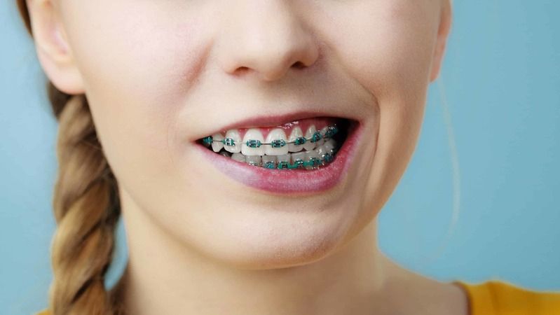Devlet Hastaneleri Diş Teli Takar Mı? 2020 Devlette Diş Teli Tedavisi Fiyatları 5