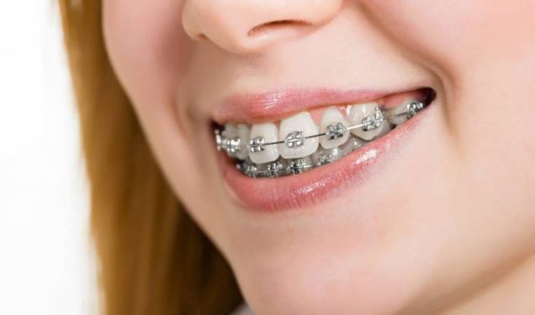 Devlet Hastaneleri Diş Teli Takar Mı? 2020 Devlette Diş Teli Tedavisi Fiyatları 2