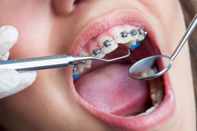 Devlet Hastaneleri Diş Teli Takar Mı? 2020 Devlette Diş Teli Tedavisi Fiyatları 3