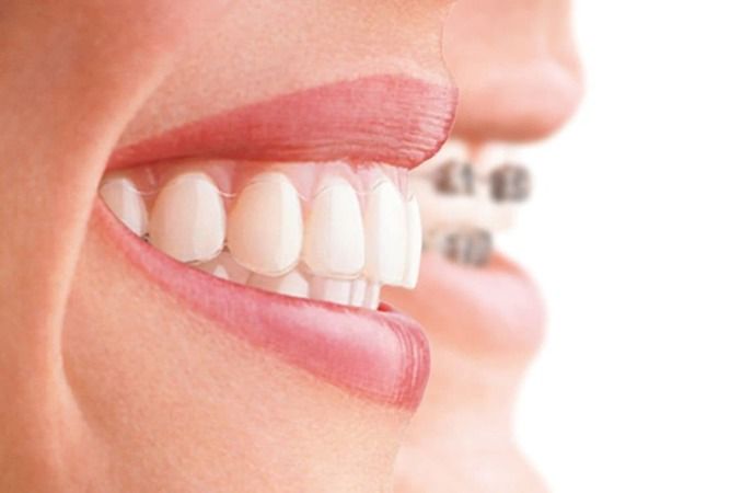Devlet Hastaneleri Diş Teli Takar Mı? 2020 Devlette Diş Teli Tedavisi Fiyatları 4