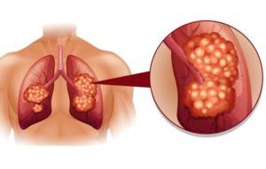 Akciğer kanseri, tüm kanser ölümlerinin yüzde 25'ini oluşturuyor 2