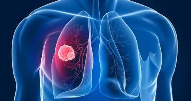 Akciğer kanseri, tüm kanser ölümlerinin yüzde 25'ini oluşturuyor 1