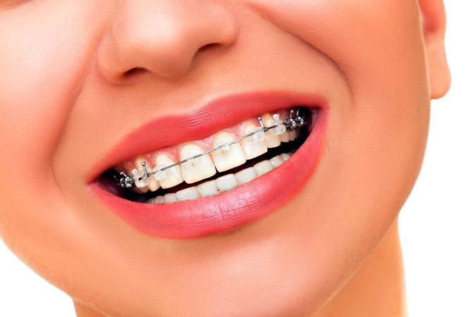 Diş Teli Olanlar Nelere Dikkat Etmeli? 2