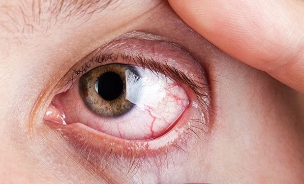 Göz tümörü nedir, belirtileri nelerdir? Nasıl tedavi edilir? 3
