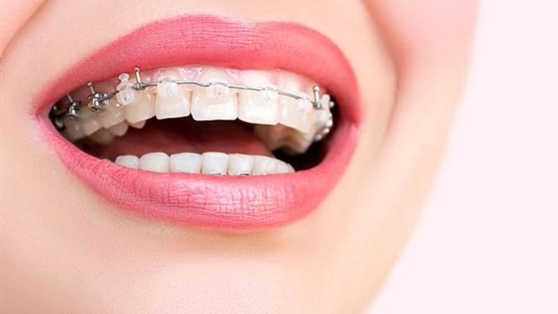 Diş Teli Fiyatları Ne Kadar? 2021 Diş Teli Fiyatı Nasıl Hesaplanır, Ne Kadar Sürede Takılır? 1