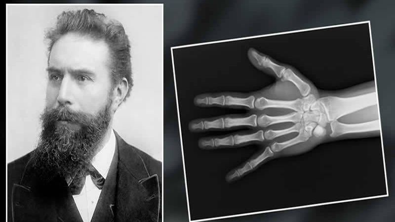 Röntgen Nedir Ne İse Yarar? Röntgen Neyi Gösterir? Röntgen Çekimi Nasıl Yapılır, Rötgeni Kim Bulmuştur? 3