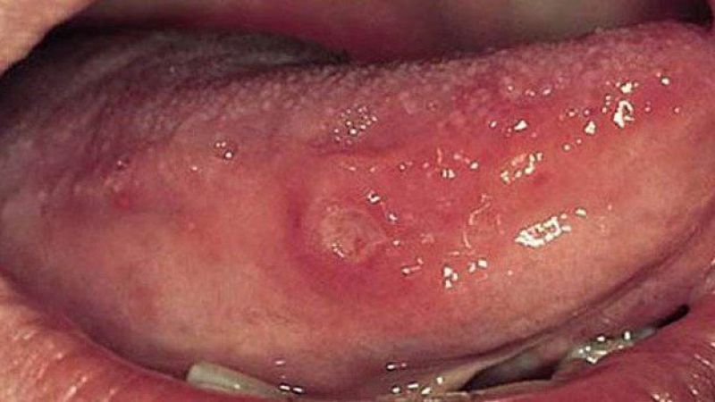 Evde Dil Yarası Nasıl Geçer? Dilde Çıkan Yaralar Neyin Habercisi? Dil Yarasına Hangi İlaç Kullanılır? 2