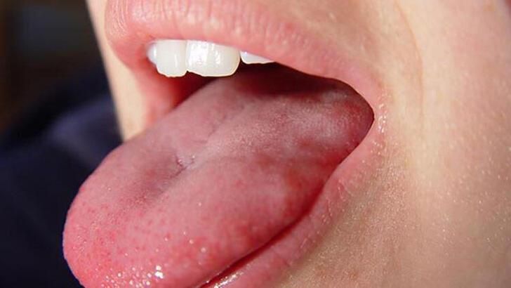 Evde Dil Yarası Nasıl Geçer? Dilde Çıkan Yaralar Neyin Habercisi? Dil Yarasına Hangi İlaç Kullanılır? 3