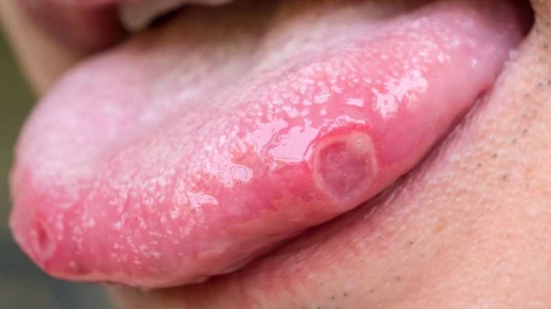 Evde Dil Yarası Nasıl Geçer? Dilde Çıkan Yaralar Neyin Habercisi? Dil Yarasına Hangi İlaç Kullanılır? 1