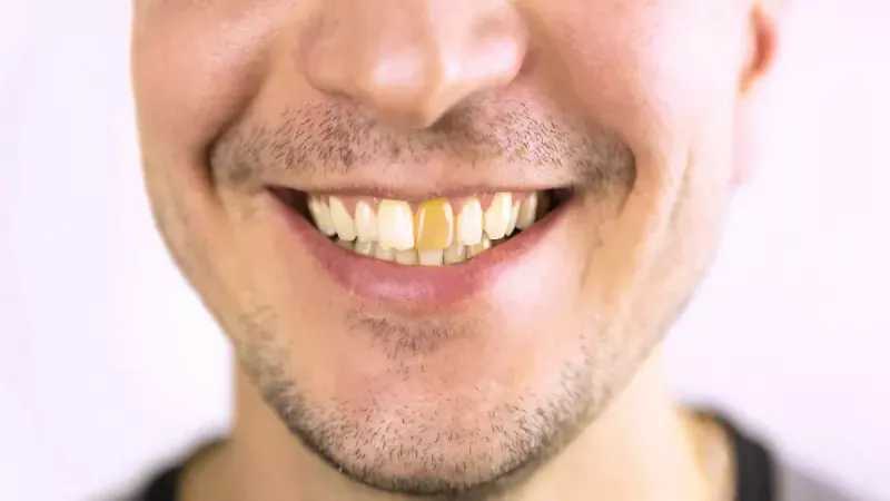 Diş Sararması Nasıl Geçer? İşte Bembeyaz Dişler İçin O Formül... Karbonat ve Limon suyu Dişleri Beyazlatıyor! 2