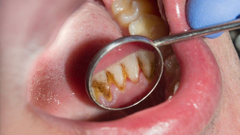 Diş Sararması Nasıl Geçer? İşte Bembeyaz Dişler İçin O Formül... Karbonat ve Limon suyu Dişleri Beyazlatıyor! 3