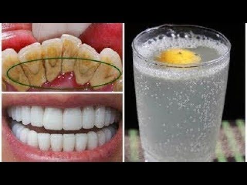 Diş Sararması Nasıl Geçer? İşte Bembeyaz Dişler İçin O Formül... Karbonat ve Limon suyu Dişleri Beyazlatıyor! 4