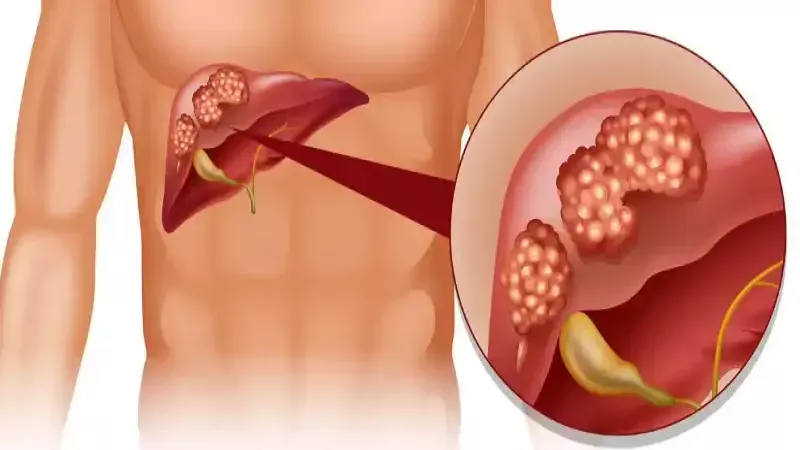 Bu 4 İşaret Ölümcül Karaciğer Hastalığının Habercisi! İlk Aşamadaki Siroz Belirtileriyle Erken Tedavi Mümkün 4
