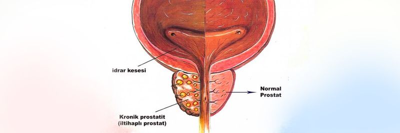 Prostatit Hastalığına Yüzde 99 Çözüm Oluyor: Sadece İki Malzeme İle Yapılıyor! Aman Dikkat Her Gün Tüketmek Gerekiyor! İşte Formül 2