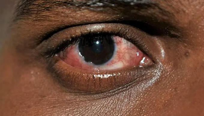 Alarm: Bulaşıcı Kırmızı Göz Hastalığı Yeni Kabusumuz Olabilir!