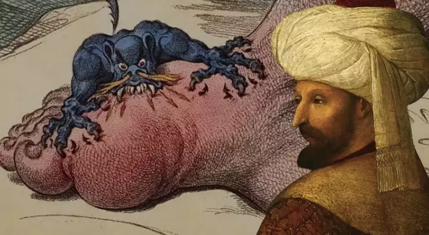Fatih Sultan Mehmet'in Hastalığı Yeniden Günümüzde! Yüzyıllar Sonra Gut Hastalığı Gençler Arasında Yeniden Yükselişte!