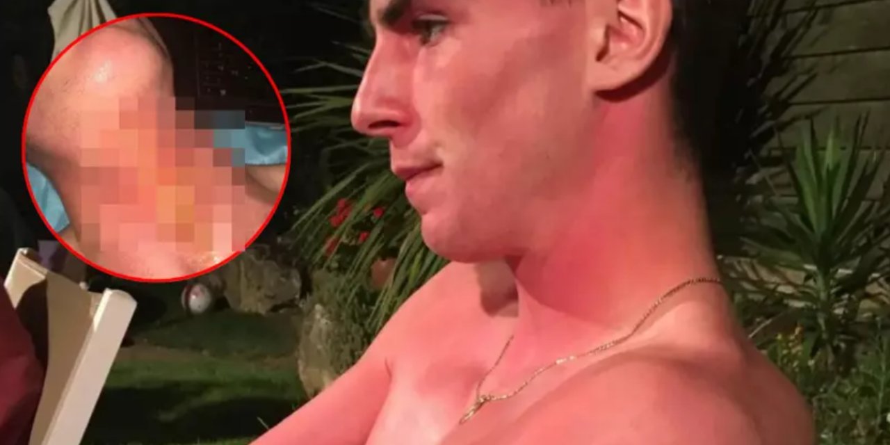 Tatil Felakete Döndü! Altın Kolyeyle Güneşte Uyudu, Boynu Resmen Yandı!