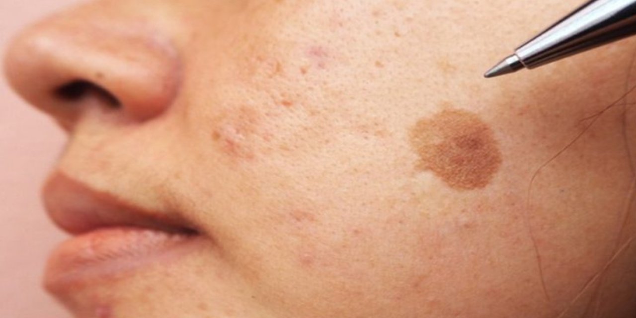 Dermatoloji Uzmanı Uyardı: Yaz Sonrası Cilt Lekelerine Karşı Ne Yapmalı?