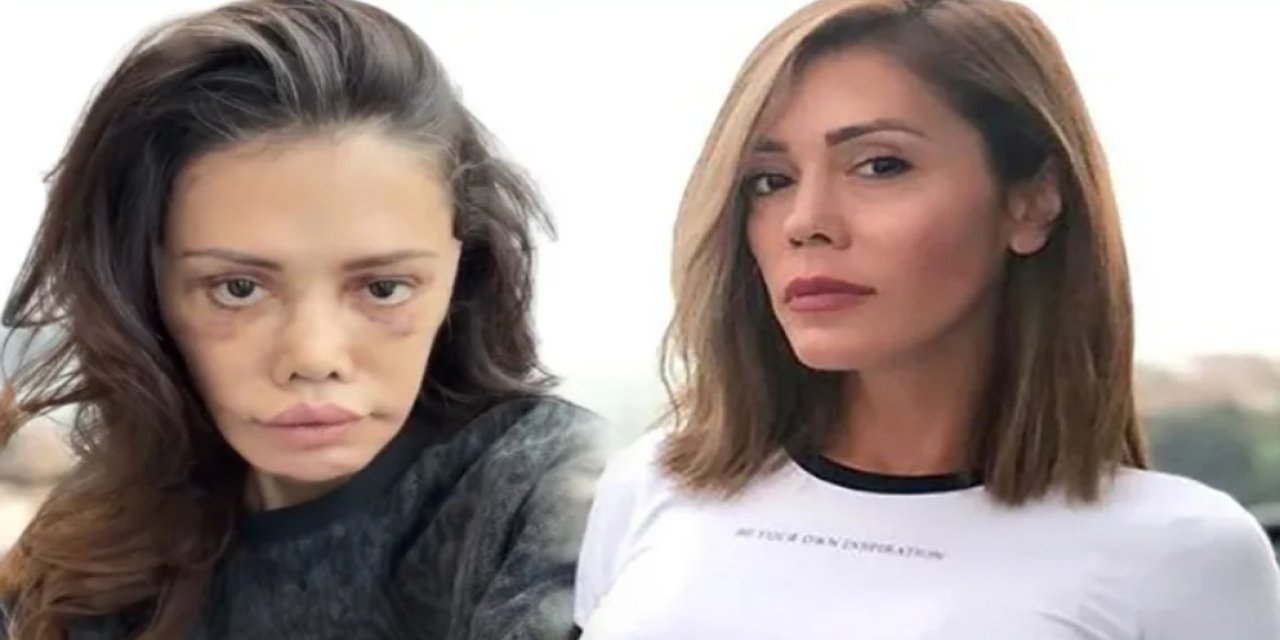Didem Ceran’ın Yeni Hali Olay Oldu! Yüz Nakli Sonrası Görüntüsü Sosyal Medyayı İkiye Böldü
