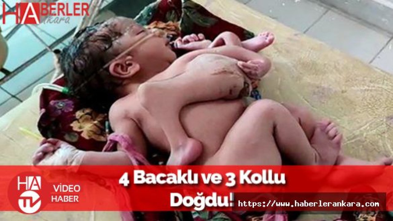 Dünya Şok İçerisinde: 4 Bacaklı 3 Kollu Çocuk Doğdu!