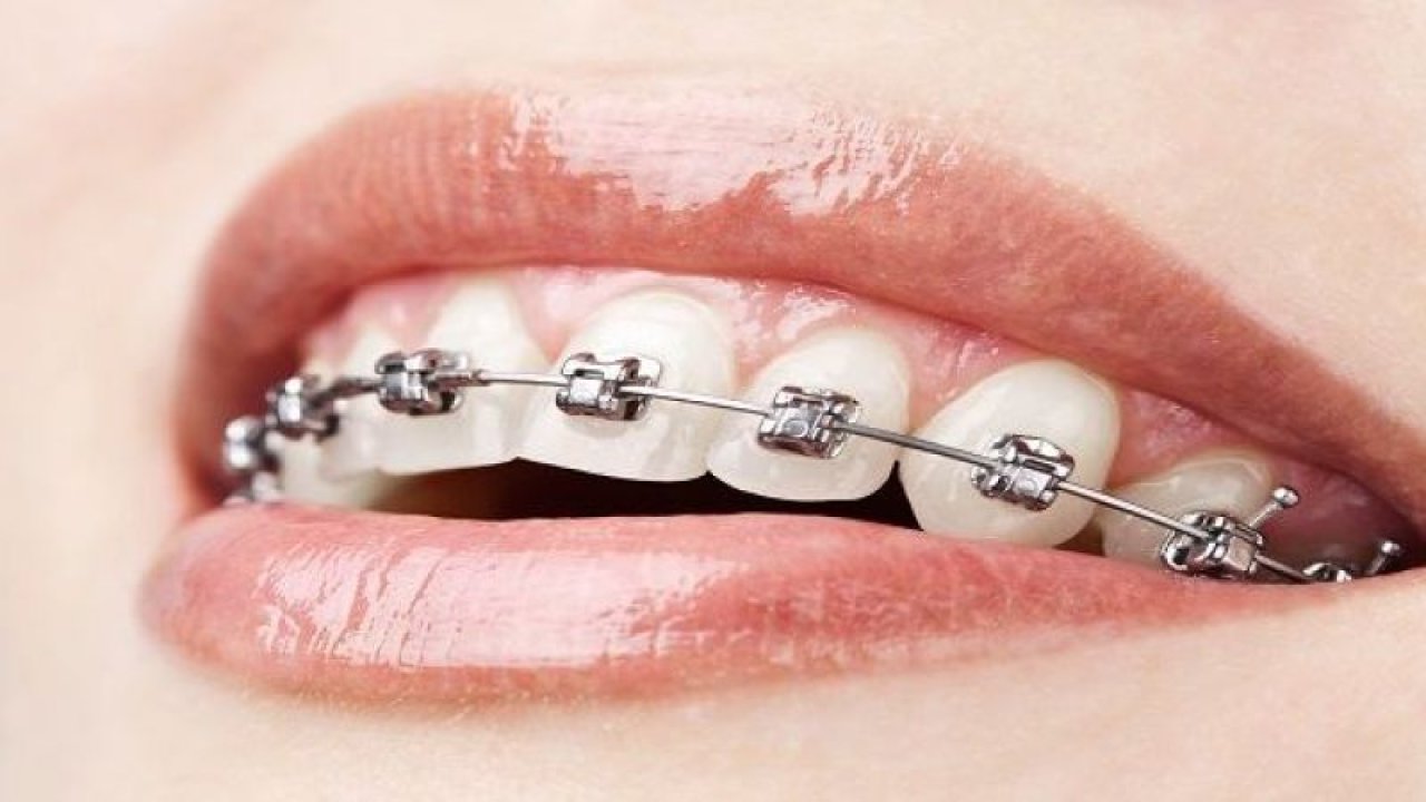 Diş teli ile ilgili doğru bilinen 7 yanlış!