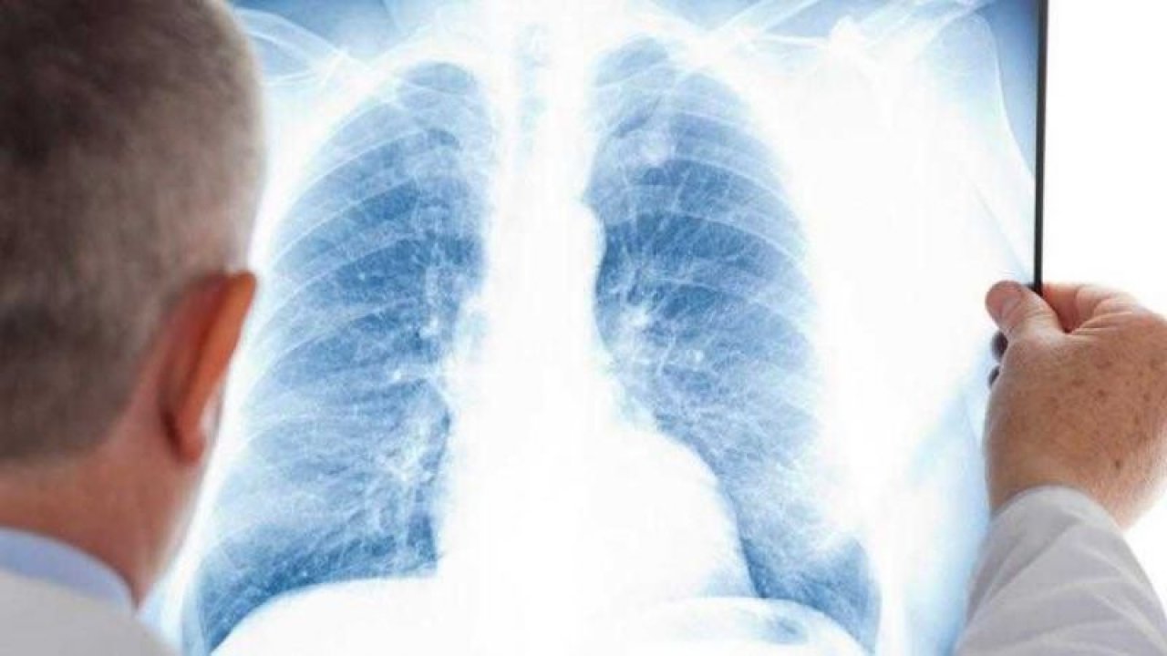 Akciğer sertleşmesi tedavisinde ÖNEMLİ Yeni gelişmeler