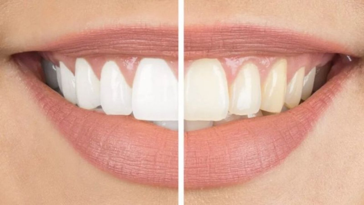 Dişler neden sararır! Sararan Diş Problemi Nasıl Çözülür?