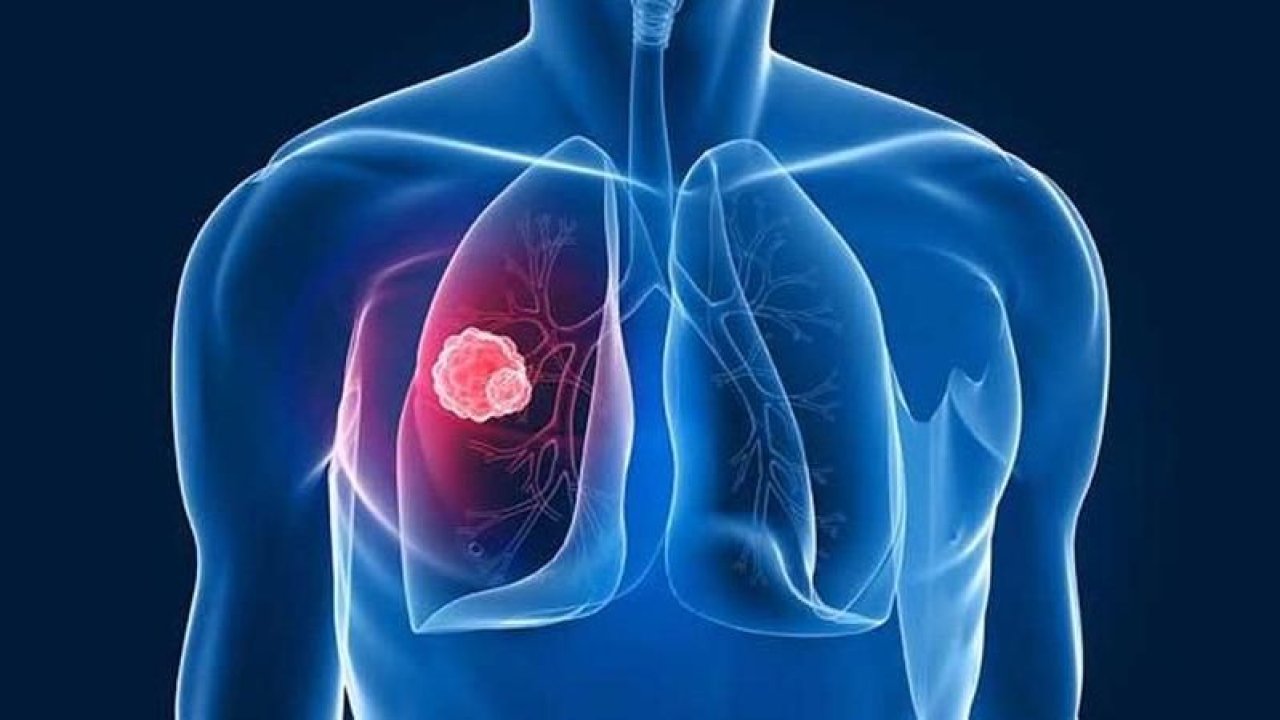 Uzmanlardan "Akciğer kanseri" uyarıları