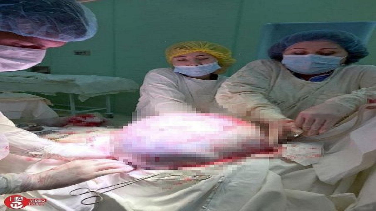 Rusya’da kadının yumurtalıklarından 25 kilogram tümör çıkarıldı