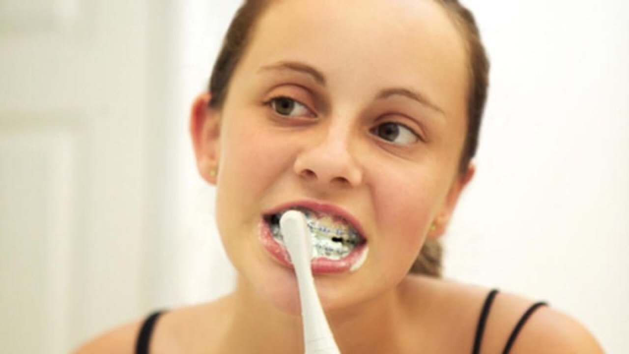 Diş Teli Olanlar Nelere Dikkat Etmeli?