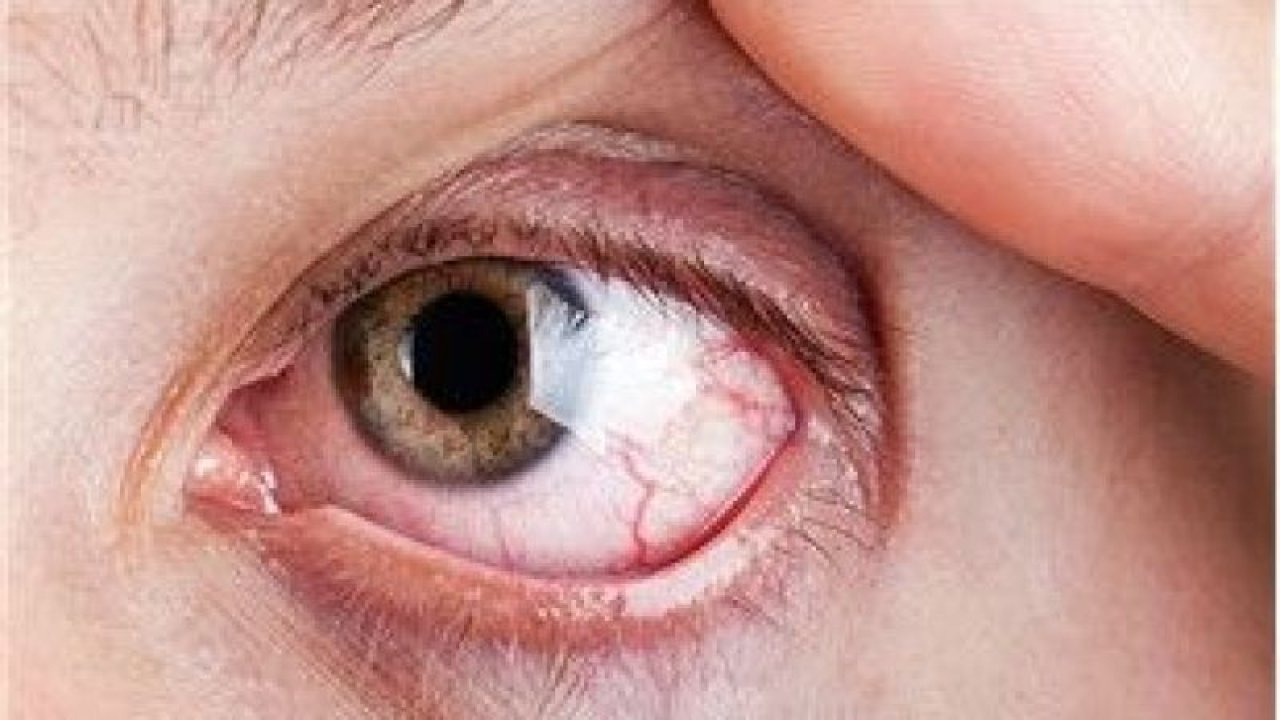 Göz tümörü nedir, belirtileri nelerdir? Nasıl tedavi edilir?