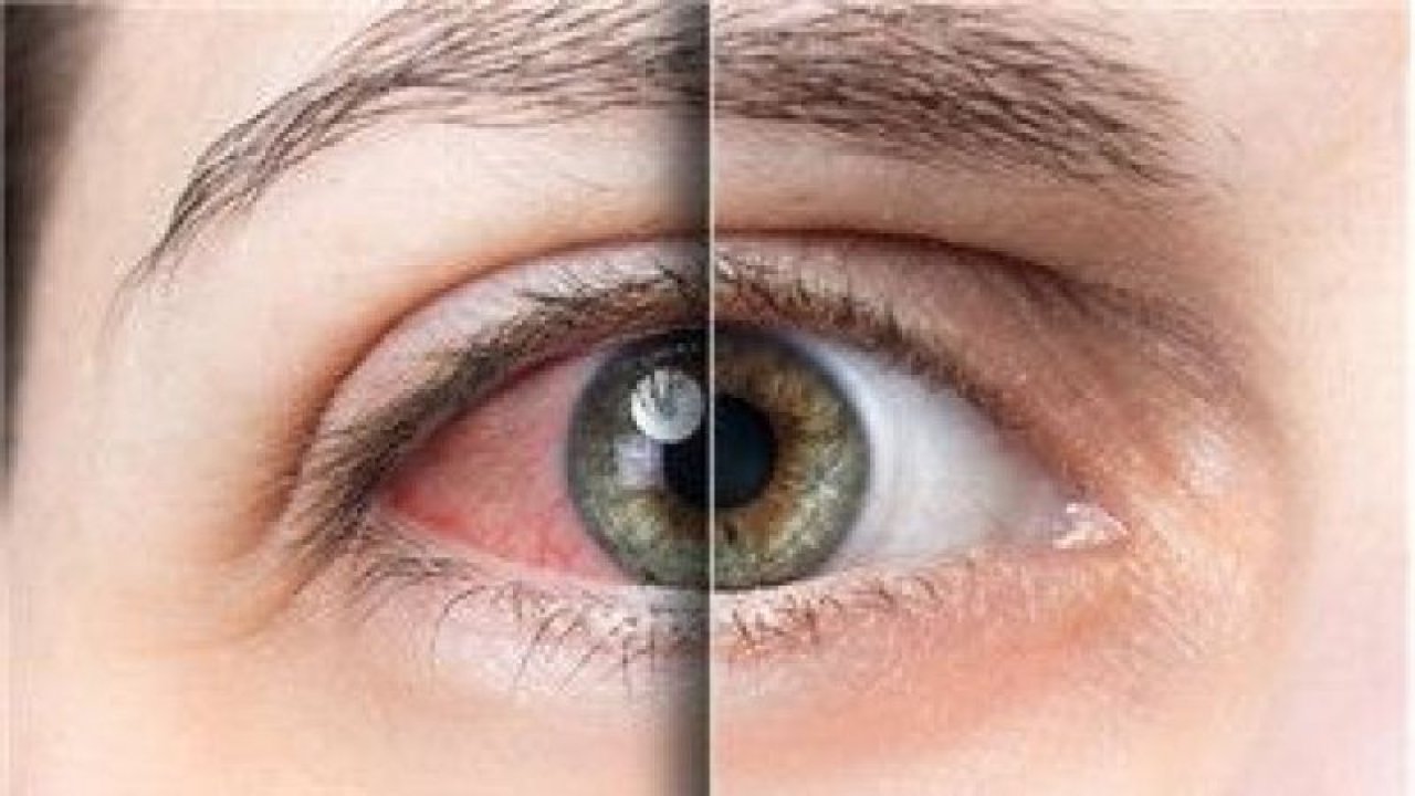 Göz Tembelliği Nedir? Göz Tembelliğinin Nedenleri ve Tedavisi Nasıl Olur?