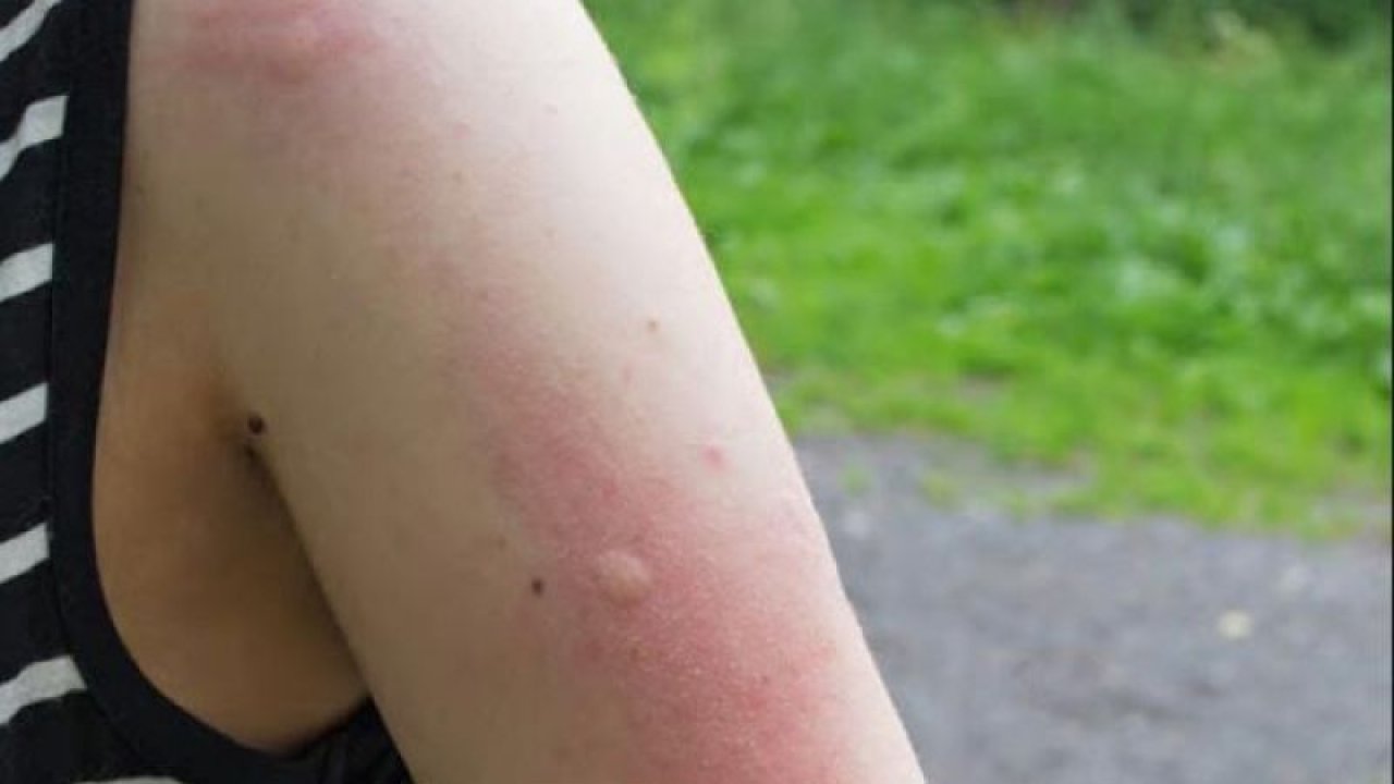 Sivrisinek Isırığı Alerjisi Ve Korunma Önlemleri
