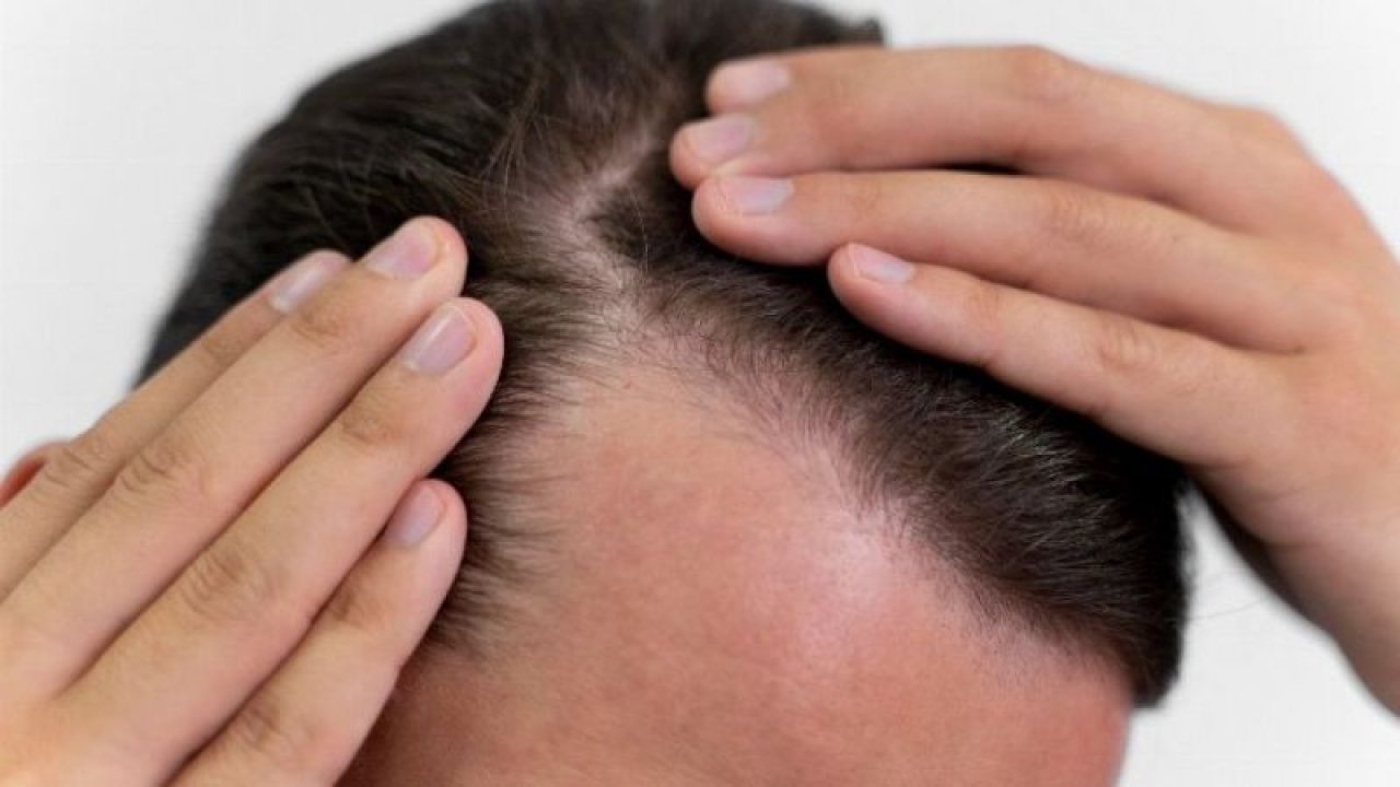 Stres saç dökülmesine neden olabilir