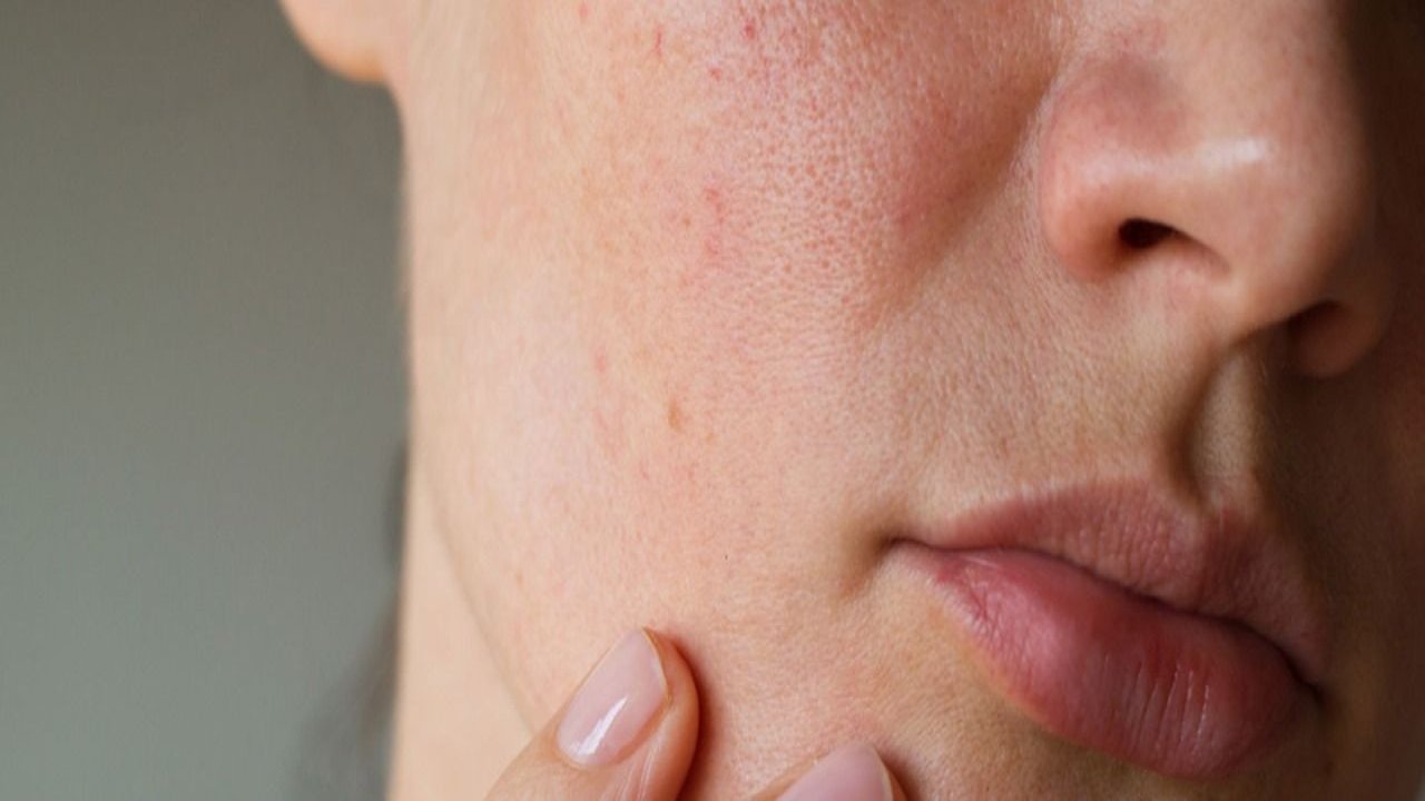 Yüzdeki Lekeler Nasıl Geçer? Yüzdeki Lekelerden Kurtulmak İçin Ne Yapılmalı?