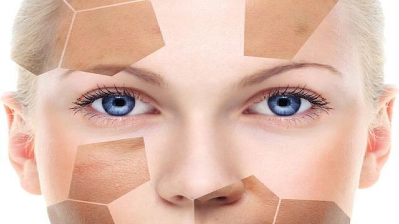 Cilt lekesi deyip geçmeyin!  Yüzde oluşan kahverengi lekeler nasıl geçer?