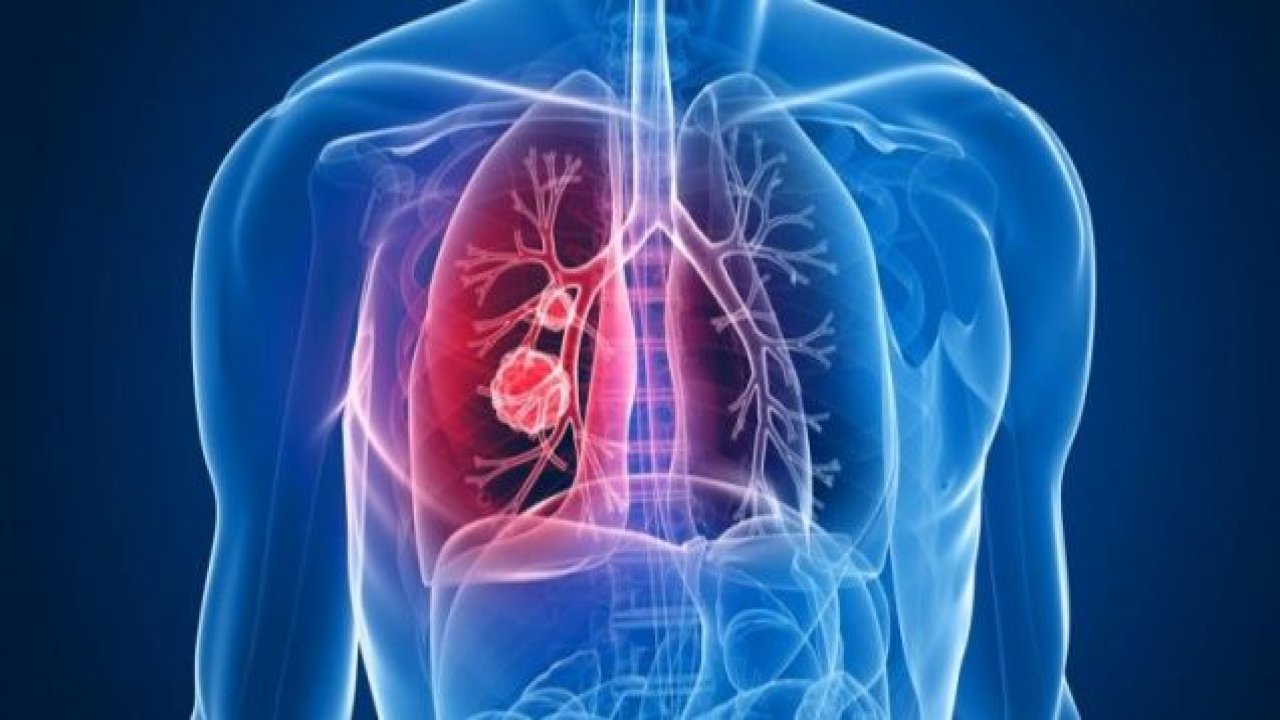 Akciğer kanserinde akıllı ilaç hangi evrede kullanılır? Akciğer kanseri hangi ilaçları kullanır? Yeni Tedavi Yöntemleri Neler ?