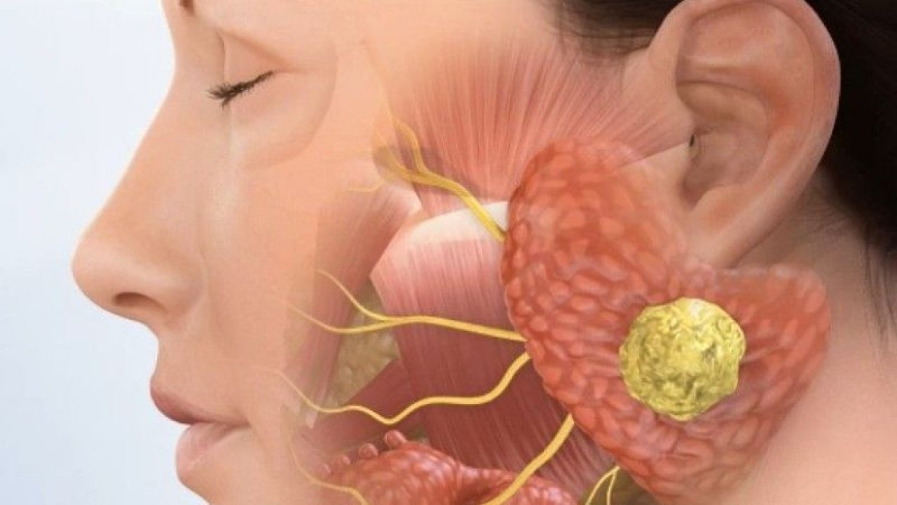 Tükürük Bezi Tümörüne Dikkat!  Tümör Nasıl Anlaşılır? Kimlerde Görülür?