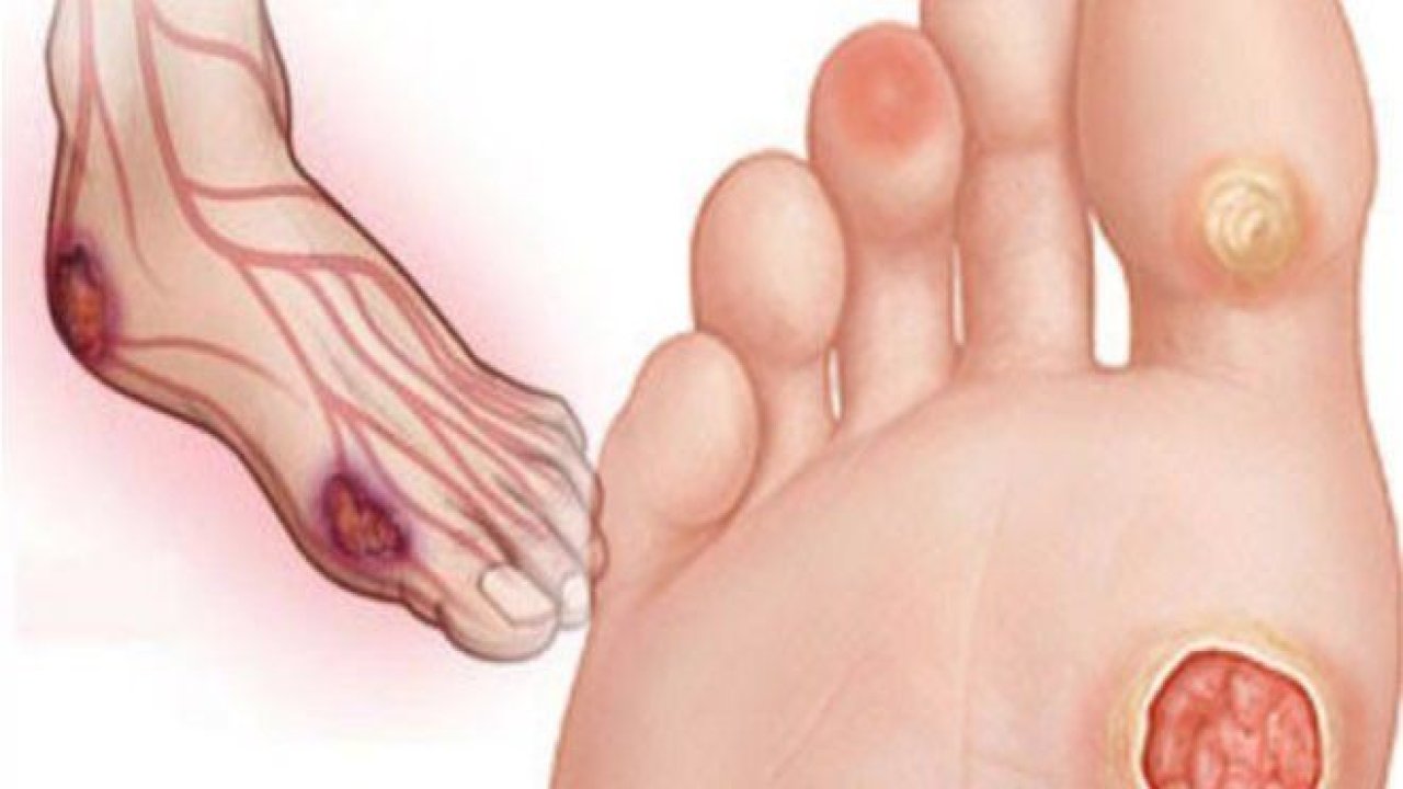 Diyabetik Ayak Yarasına Dikkat! Ayak Yarası Neden Olur? İşte Önlemenin Yolları!