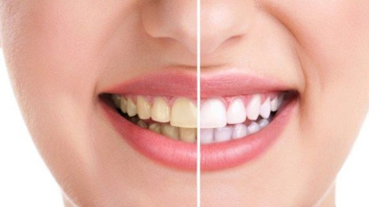 Diş Sararması Nasıl Geçer? İşte Bembeyaz Dişler İçin O Formül... Karbonat ve Limon suyu Dişleri Beyazlatıyor!