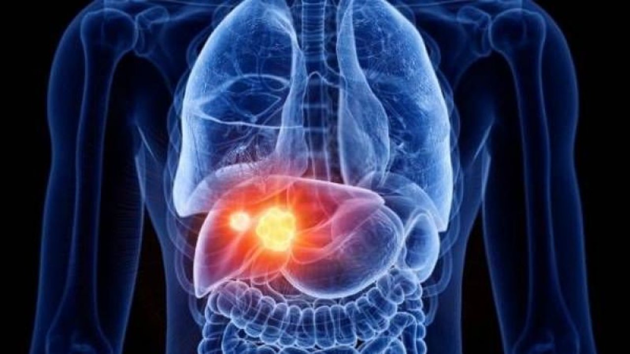 Bu 4 İşaret Ölümcül Karaciğer Hastalığının Habercisi! İlk Aşamadaki Siroz Belirtileriyle Erken Tedavi Mümkün